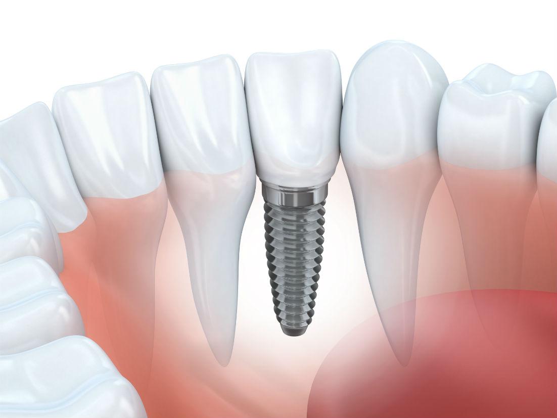 Dental Implants Cedar Rapids